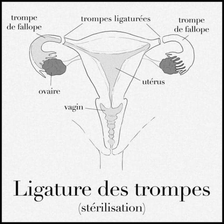 ligature des trompes