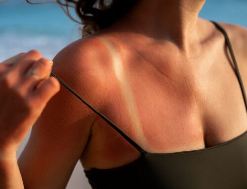 Coup de soleil : comment le soulager efficacement